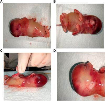 Case Report: Early diagnosis of lethal multiple pterygium syndrome with micrognathia: Two novel mutations in the CHRND gene